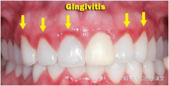 我们知道,正常的牙龈是呈现粉色,略有光泽,紧贴于牙颈周围及邻近的牙