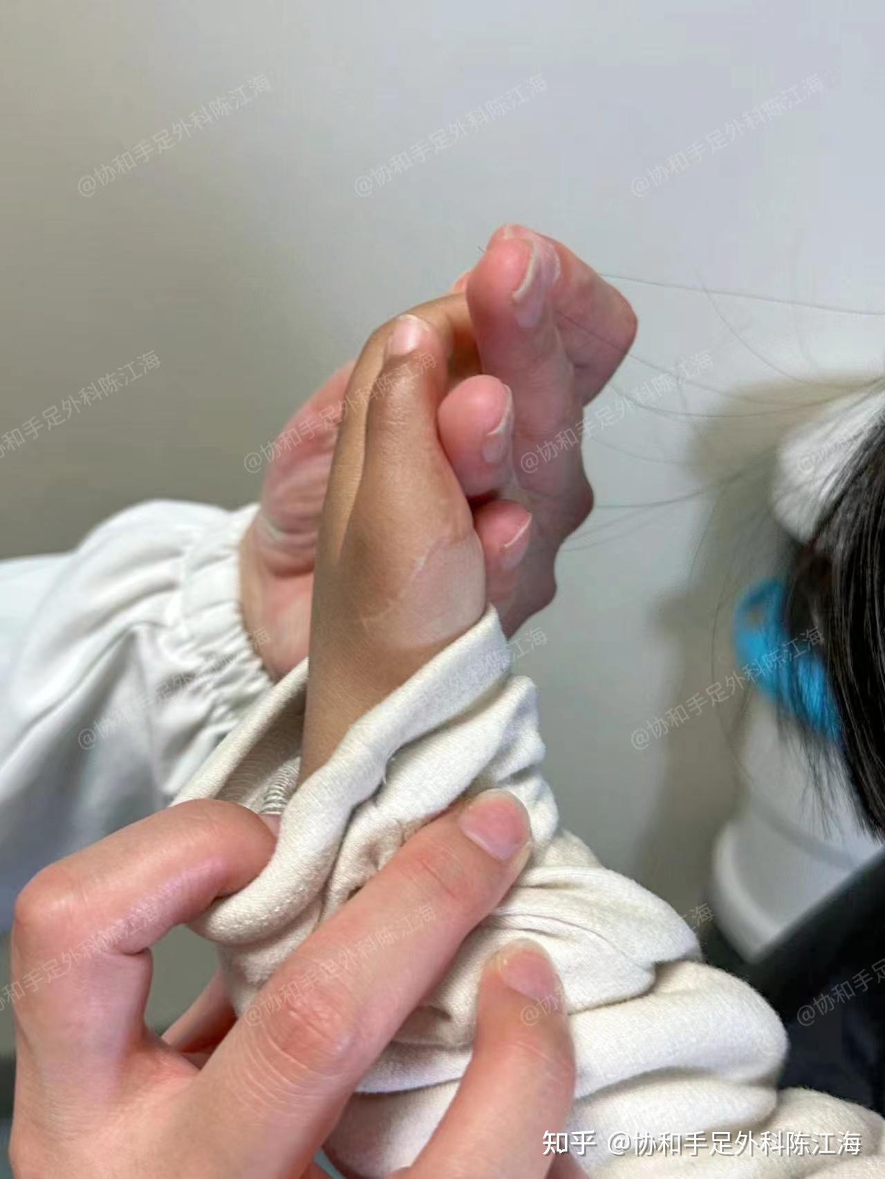 孩子出生左手六指像蟹钳,跑了2次医院,最后拇指总算"正常"了