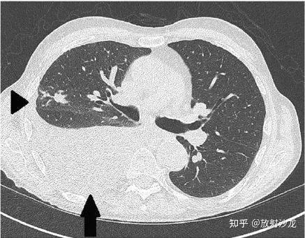 胸片、CT、B超如何定位胸水？这11张图告诉你！ - 知乎