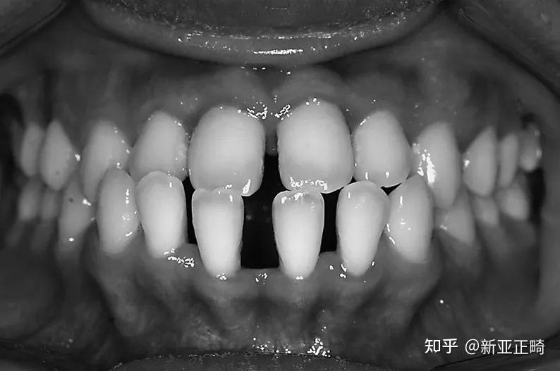 学术正畸| 错𬌗畸形的临床表现及矫治方式 - 知乎