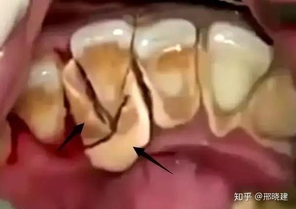 洗牙为什么会很痛 有什么问题吗 知乎