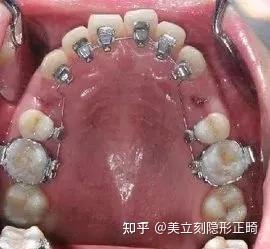 牙齿开合有哪些危害？ - 知乎