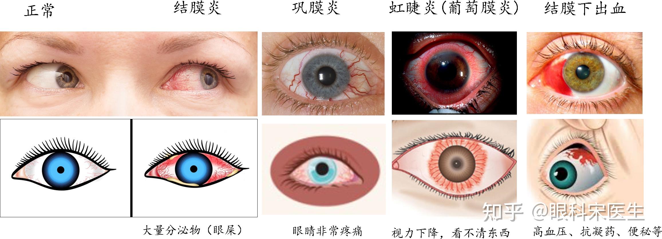 一张图区别常见眼红(结膜炎,巩膜炎,虹睫炎炎,结膜下出血) 