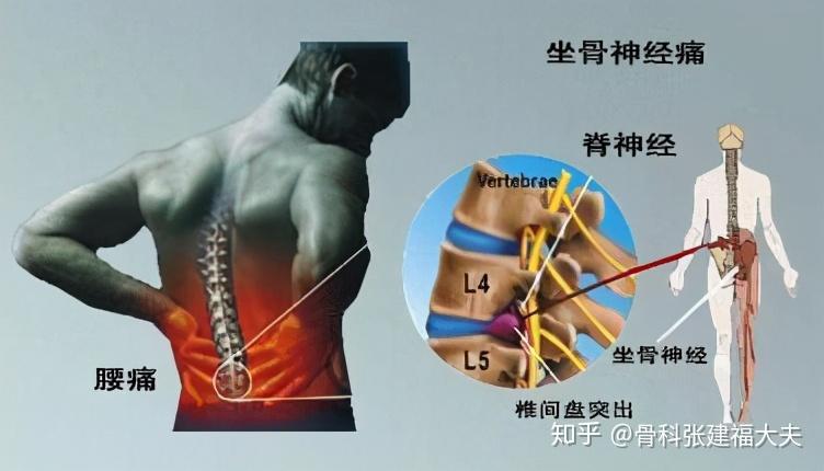 腰椎間盤突出症患者自我康復鍛鍊的秘方