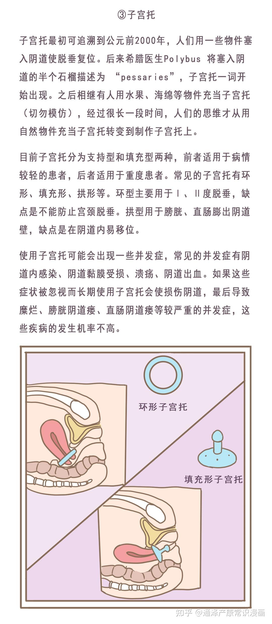 做到以下七个点让你告别「子宫脱垂」 - 知乎