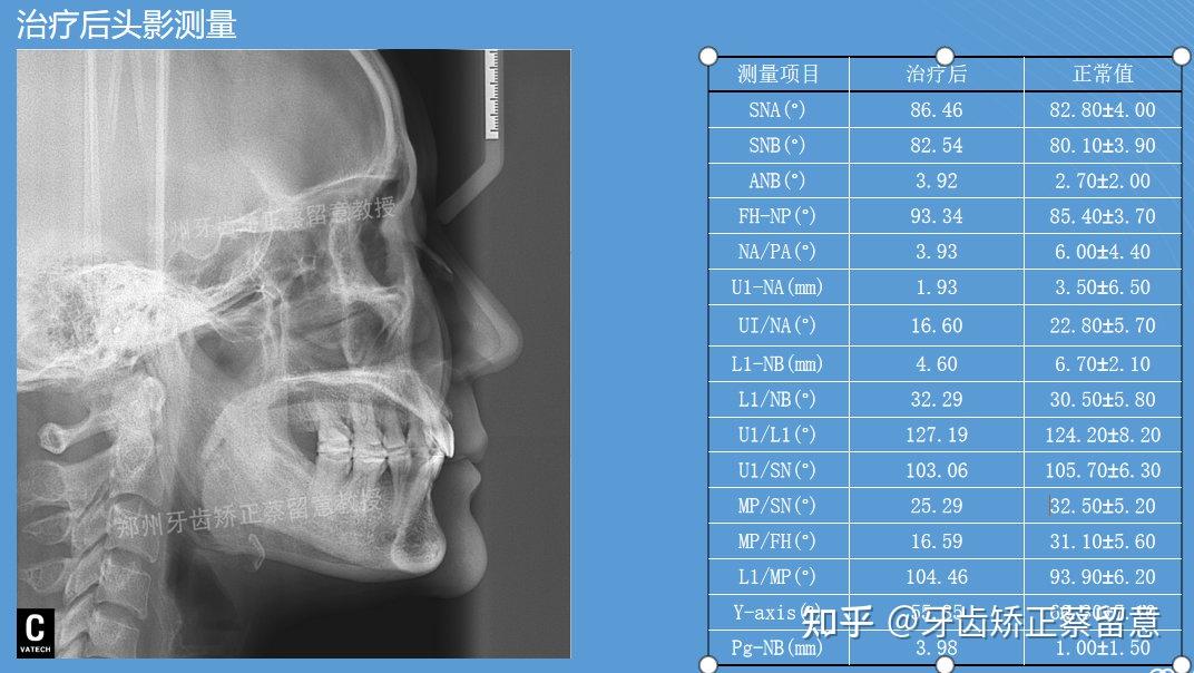 正畸病例展示ppt图片