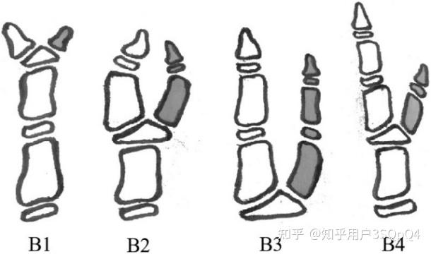 先天性拇指多指畸形,看广妇儿"吴"分型!