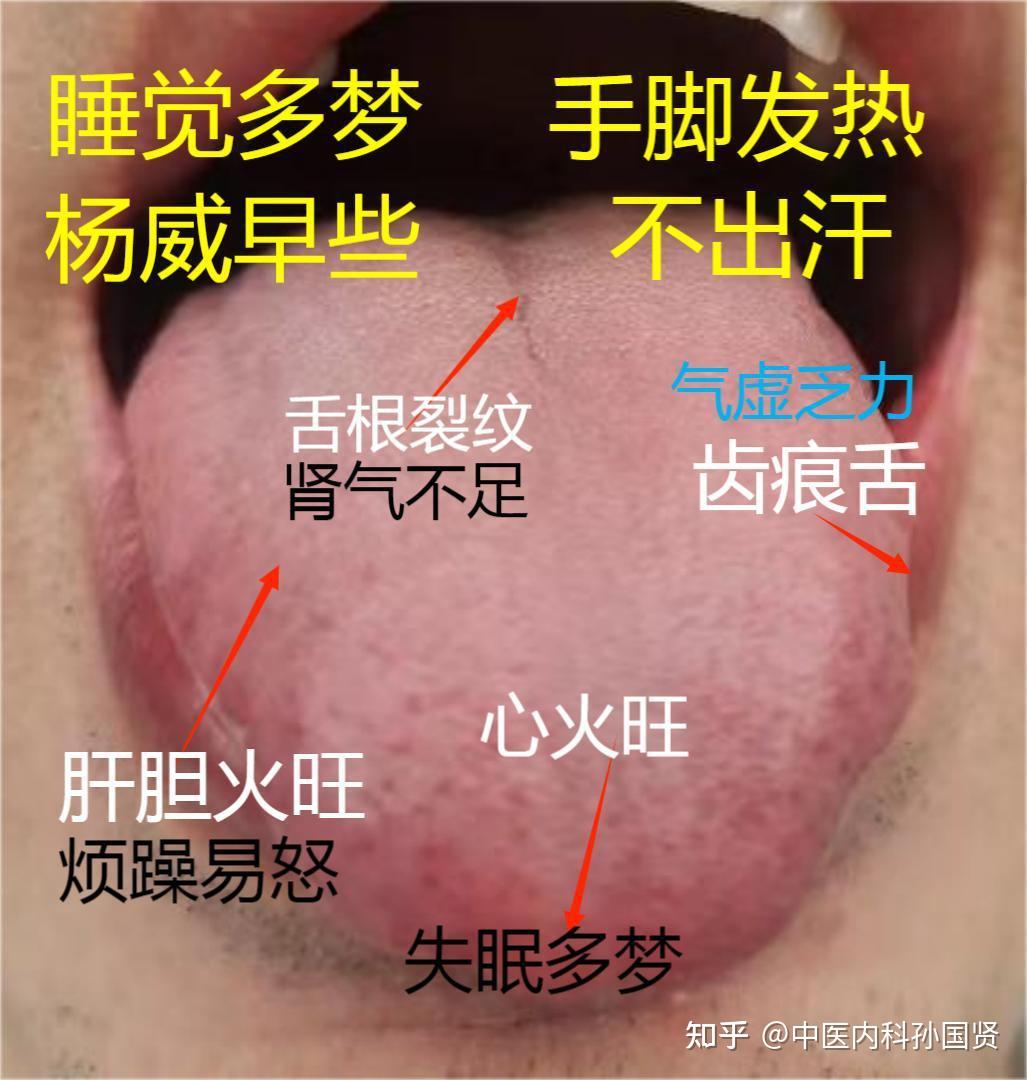 常见的3种舌象分析，你属于哪一种？失眠的你，知道什么原因吗 - 知乎