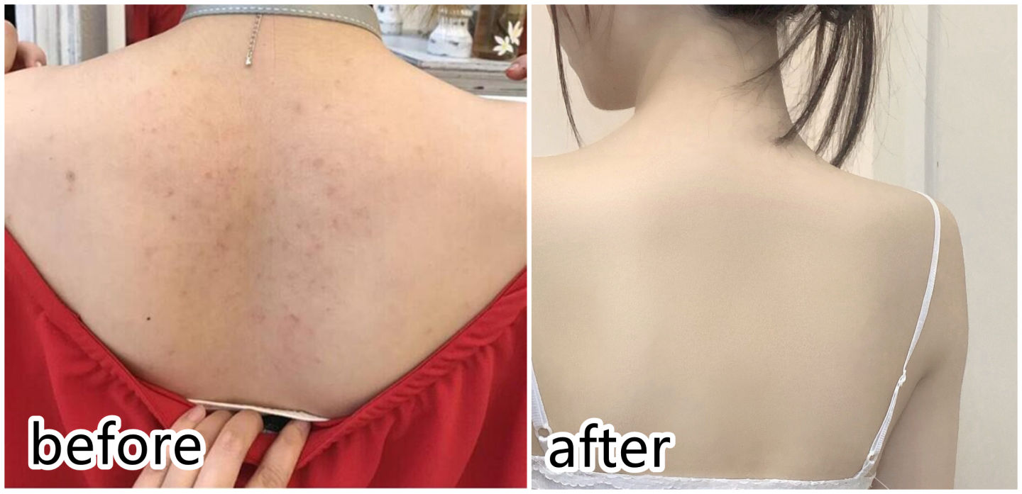 用什么产品能去掉后背痘痘高性价比的背部祛痘套装推荐来咯用到空瓶还