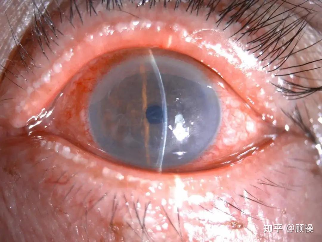 结膜混合充血,角膜水肿角膜荧光素钠染色阳性一般24~72小时后症状会