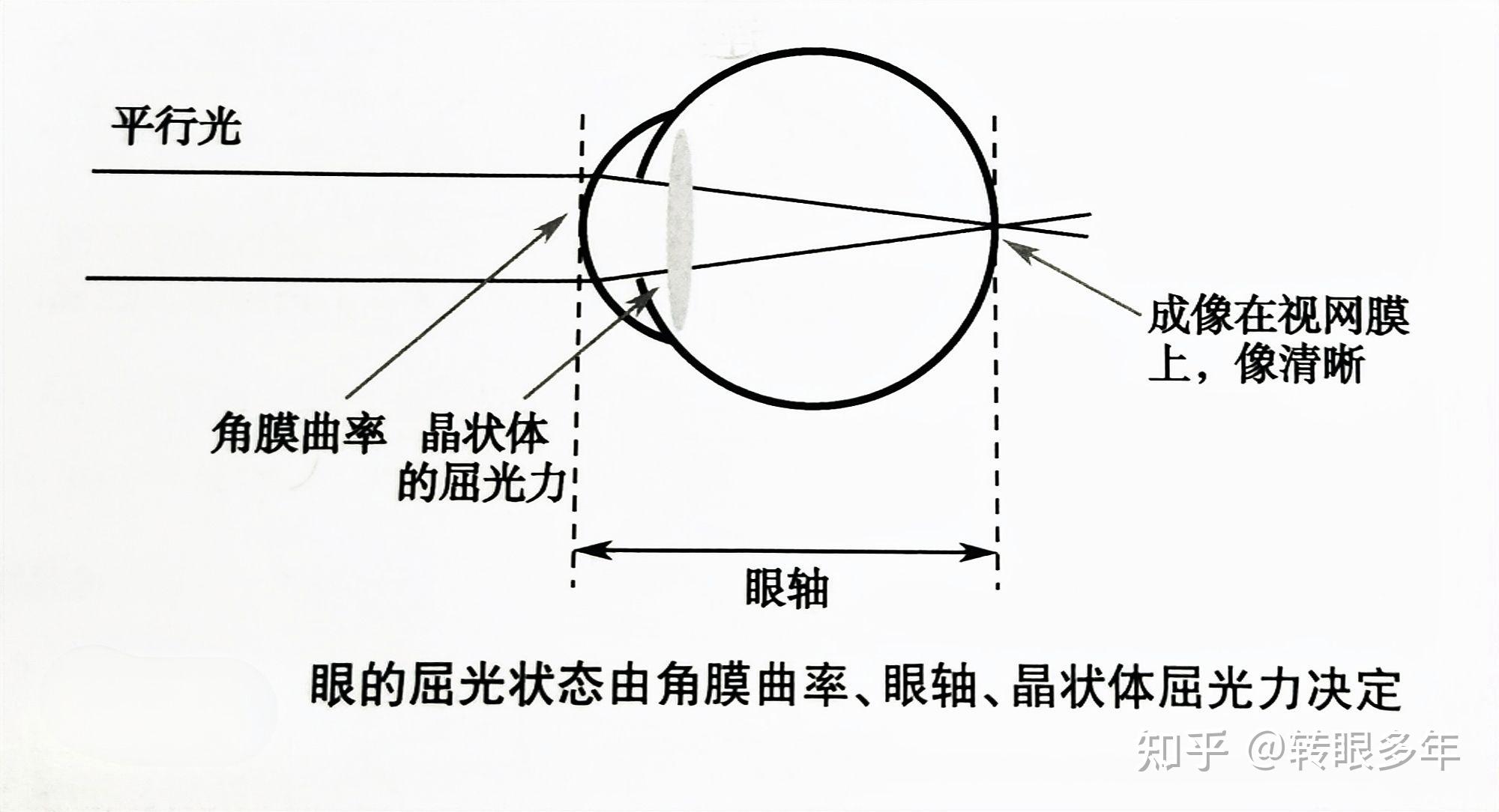 检查与近视发生发展最相关的指标:角膜曲率,眼轴,屈光度的发育情况