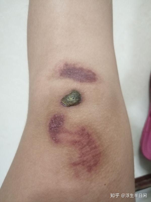 记录膝盖摔伤的康复情况