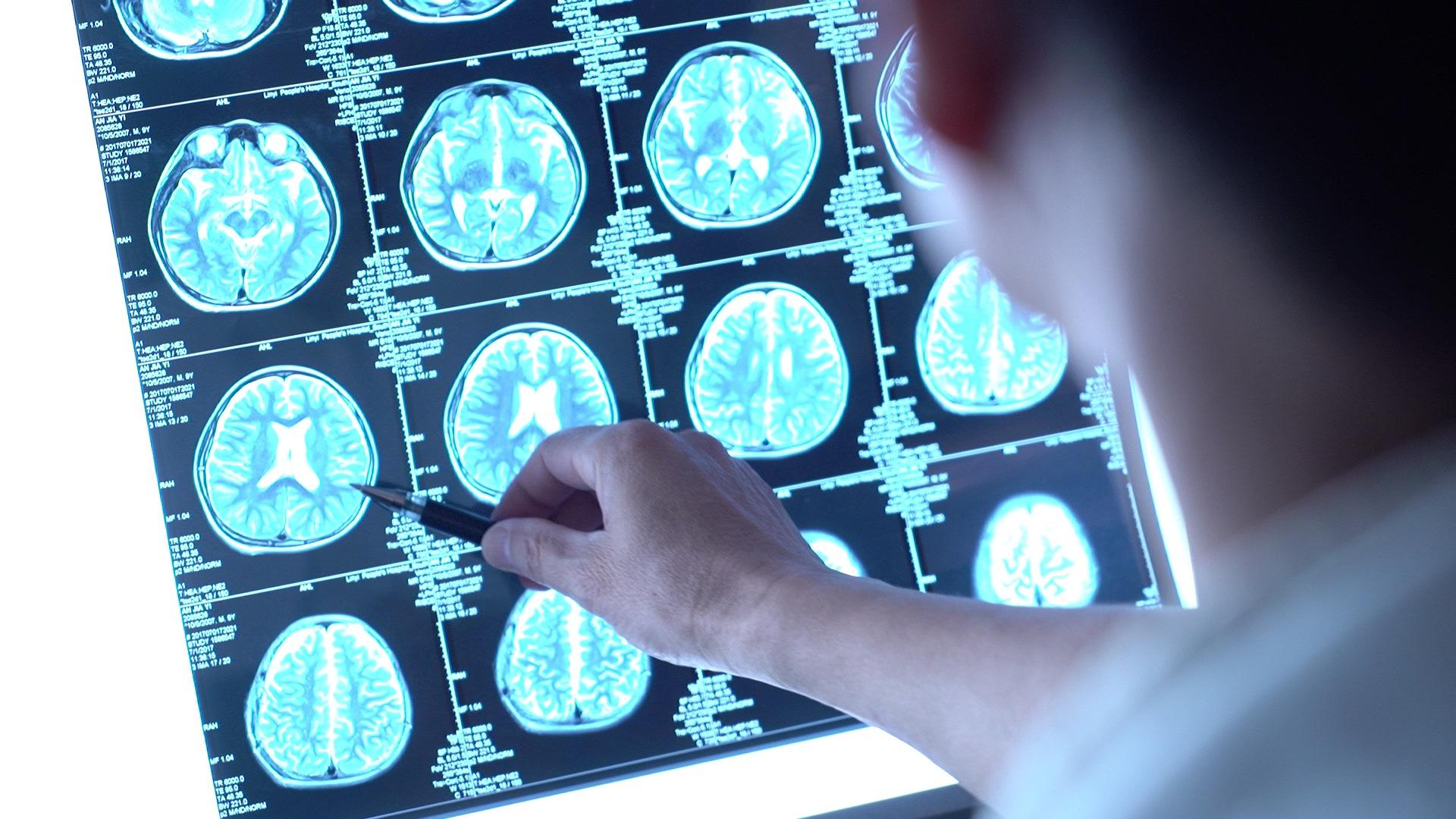 脑瘫知多少脑瘫真的是你想的那样吗