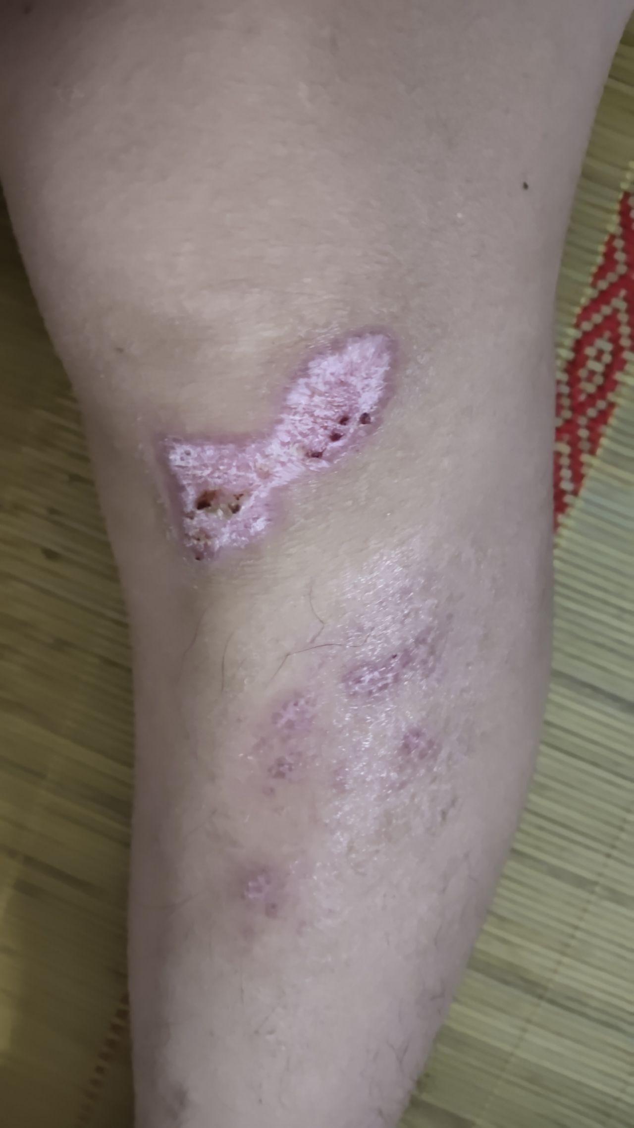 膝盖大面积擦伤