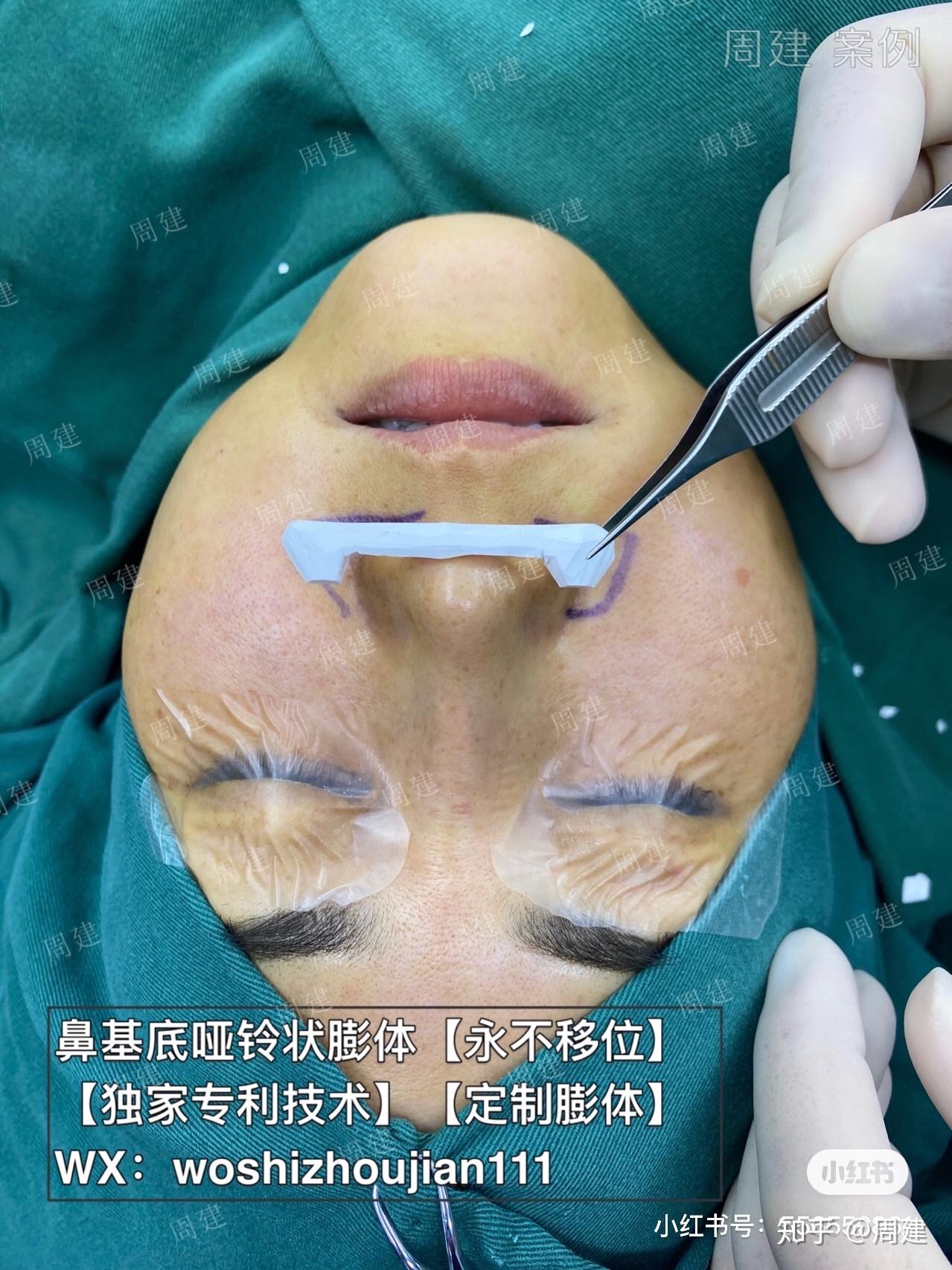 鼻基底假体怎么做才能不移位 - 知乎
