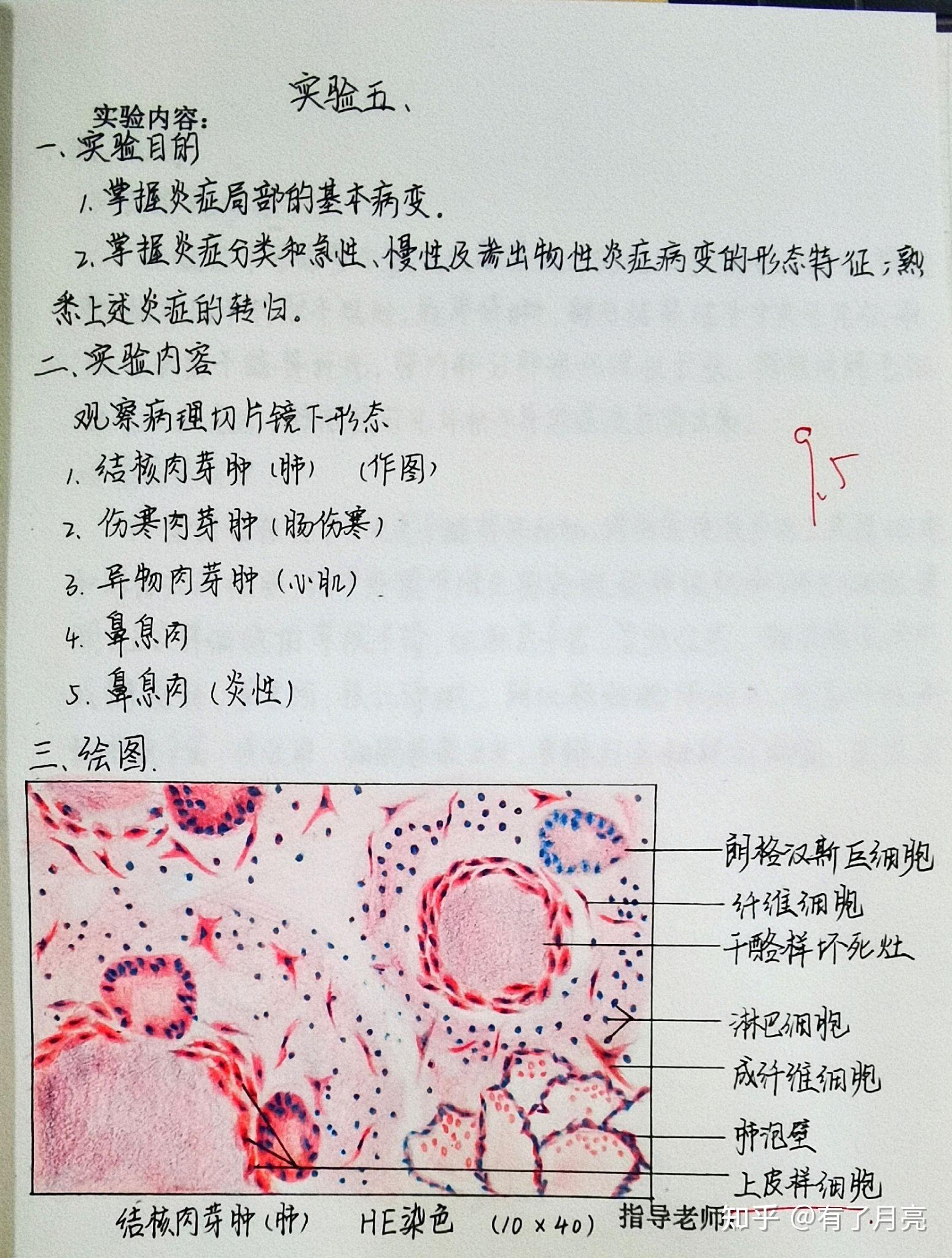5,结核肉芽肿(这个的上皮样细胞有问题,大家仅供参考哈)4,炎细胞3(2)