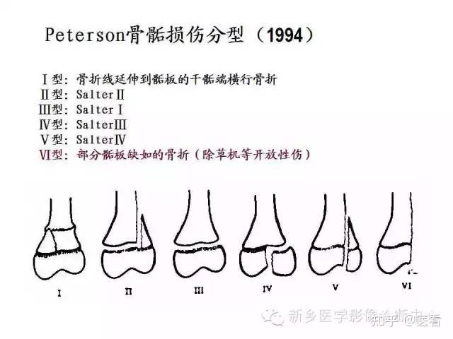 【分型】骨骺损伤的影像学分型及图解 - 知乎