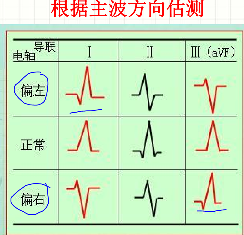 心电图part4正常心电图