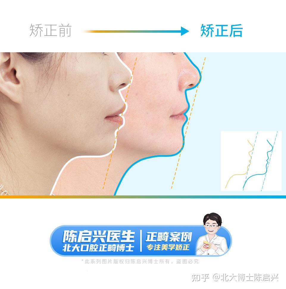 40+女性牙齿矫正案例:嘴突+深覆盖+牙齿不齐 - 知乎
