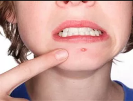 脸上长粉刺是什么原因 粉刺怎么去除 知乎