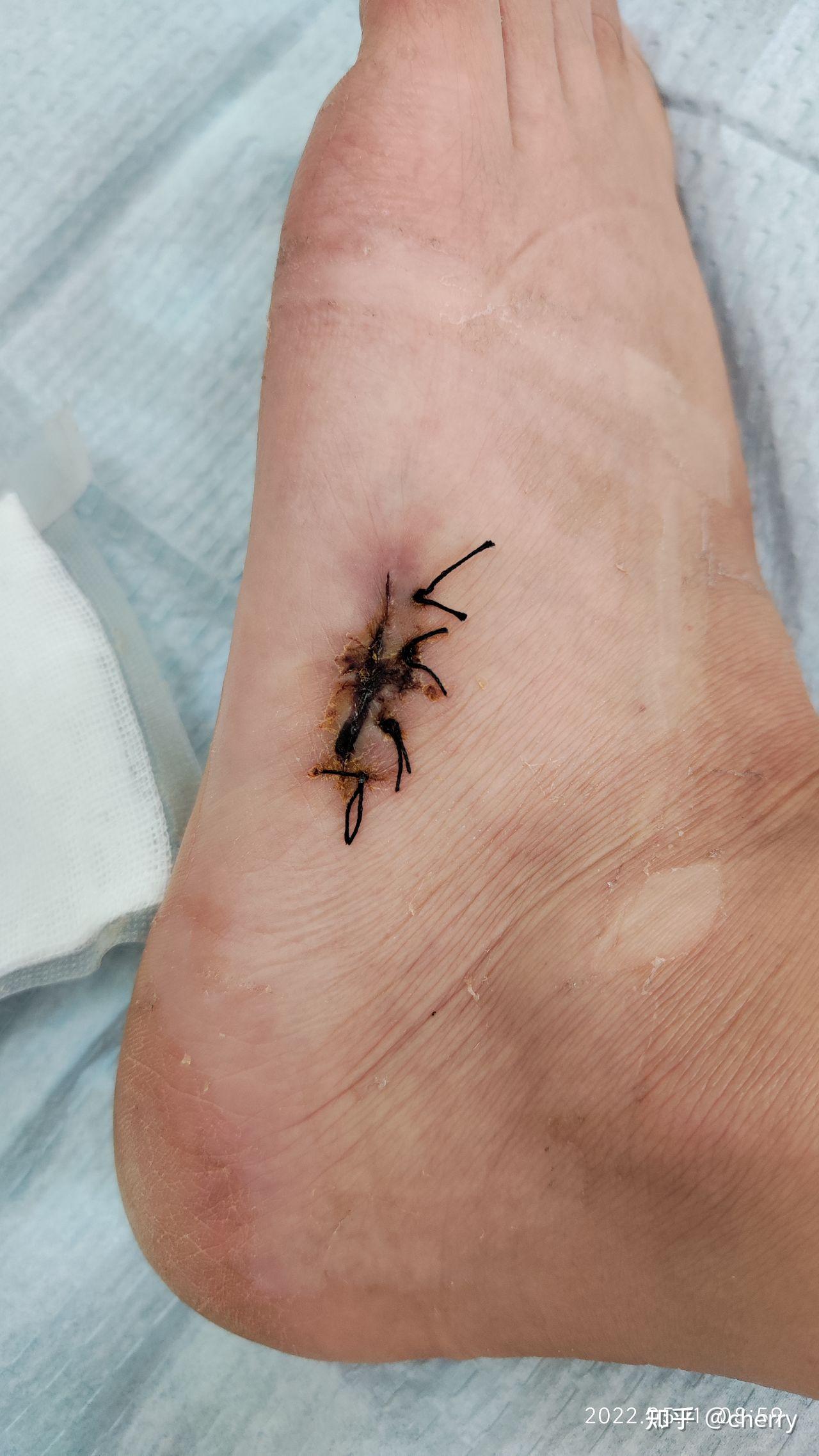 14(第17天)  拆线第4天 周末在家吃d3补钙冲剂 落脚透气 百多邦喷雾