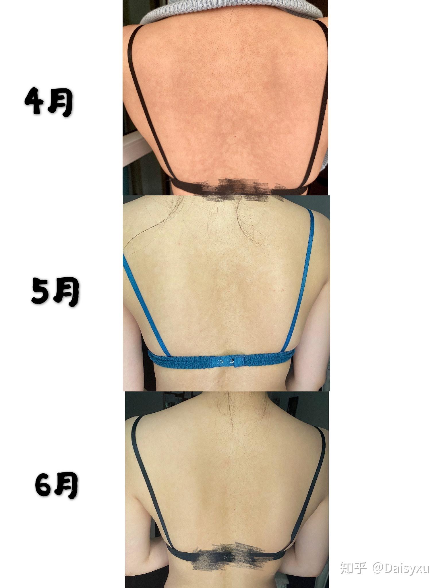 进行性斑状色素减退治疗过程