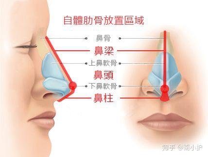 关于 网红 肋骨鼻你必须要知道的 知乎