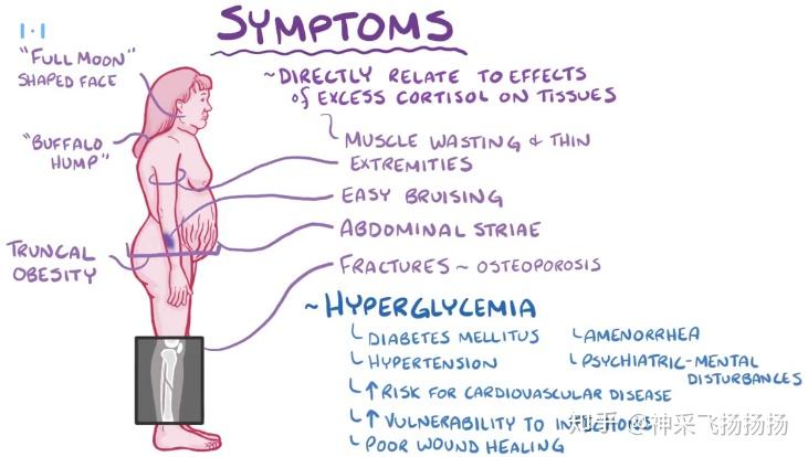 医学科普之库欣综合征Cushing Syndrome - 知乎