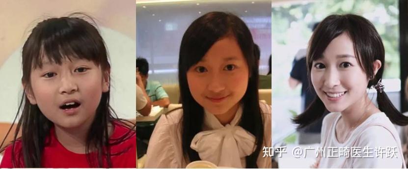 颌面发育丨为什么关晓彤没有长残,反而更出众了!