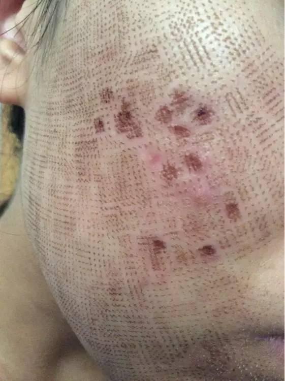 痘痘没了,留下痘印痘坑怎么办? - 知乎