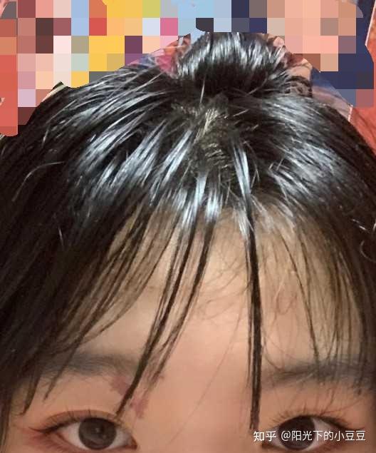 头发快秃了怎么办怎样才能头发变浓密