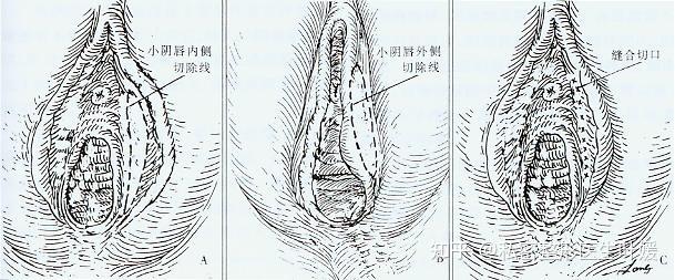 问题解答小阴唇肥大整形手术有必要吗