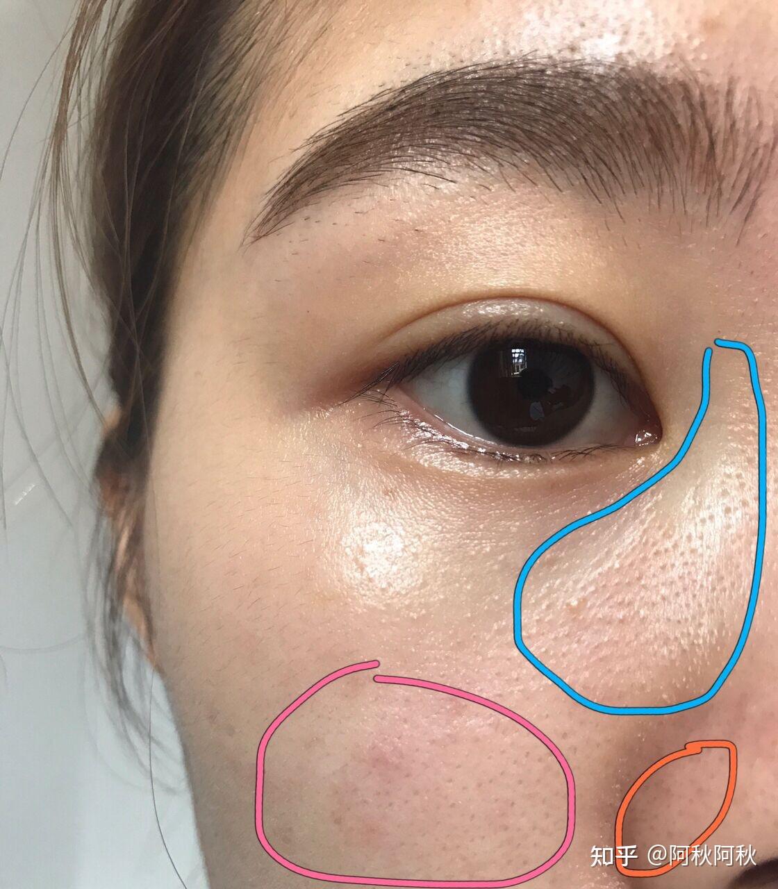 直接能把草莓鼻,黑头,闭口一扫而空的那种! - 知乎