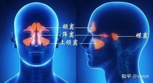鼻窦炎是怎么引起的？怎样预防？ - 知乎