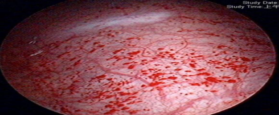 肉毒素治疗间质性膀胱炎有效吗该怎么办