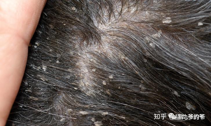 姬螯螨病引起狗的行走头皮屑.