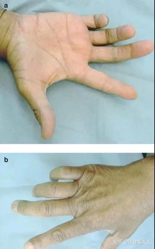 箭头指向感觉丧失区主要在手背尺侧,小鱼际,小指和无名指的尺侧一半