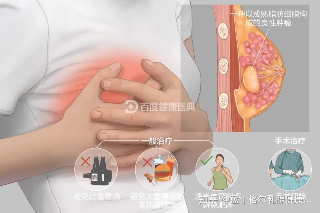 關於乳腺脂肪瘤你需要了解這些