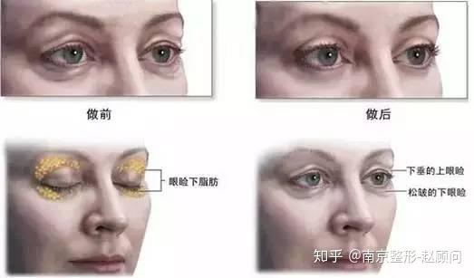 对照着瞧瞧吧!南京玖熙医疗美容1,肿泡眼肿泡眼就是