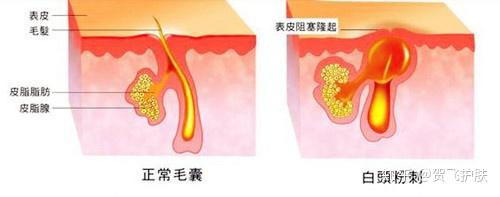 白头粉刺的形成原因与治疗过程 - 知乎