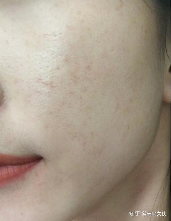 毛孔粗大真的不可逆吗刷酸能收缩毛孔吗