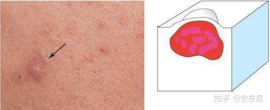 非炎症性损害①黑头粉刺(开放性粉刺)在毛囊顶部,是由于黄色色素沉积