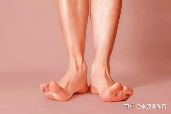 如何校正外八字脚