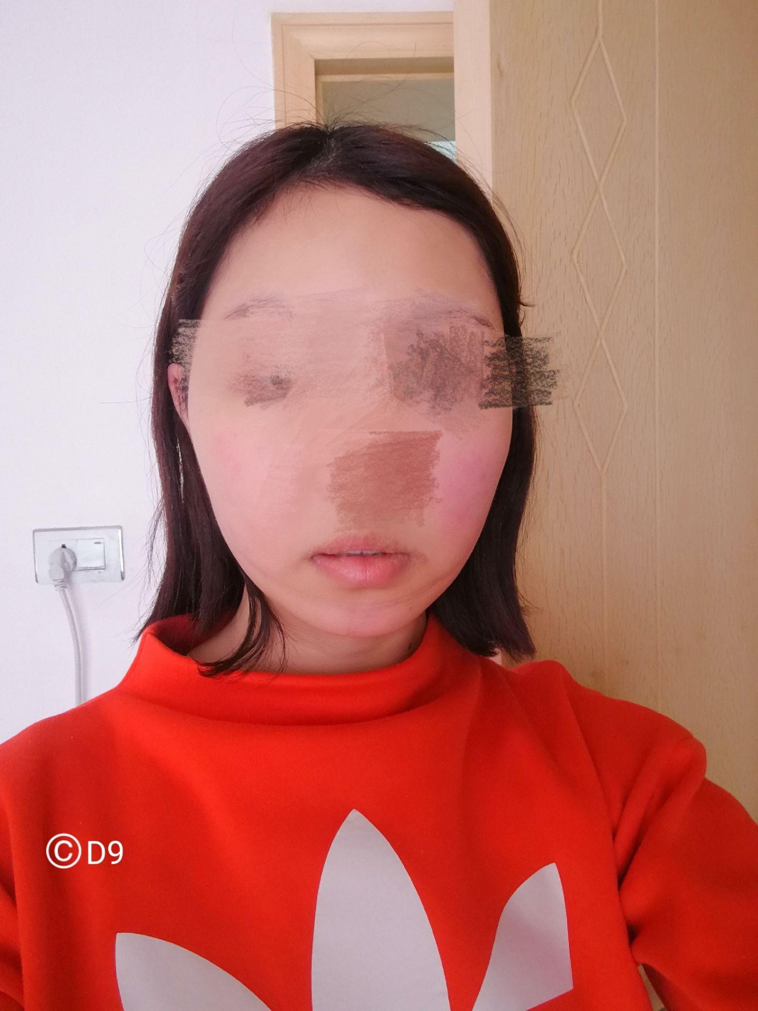 光纤溶脂,面部吸脂,瘦脸针,请做过的女生来,不要