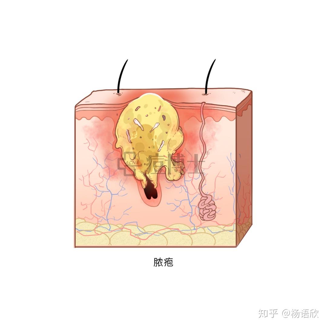 科普解析|痤疮的分型分类(你的痘痘到底是哪种) - 知乎