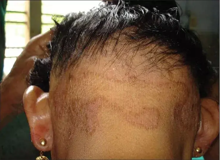 图1 头皮弥散性脱发在患者头皮的五个不同部位做头发牵拉测试结果正常