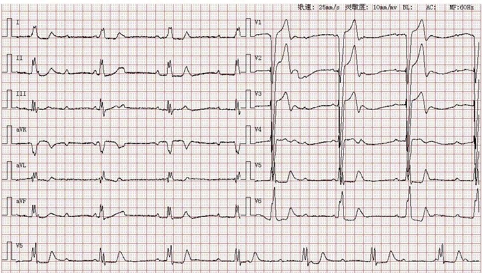 心电图图库丨(高度)三度房室传导阻滞系列 
