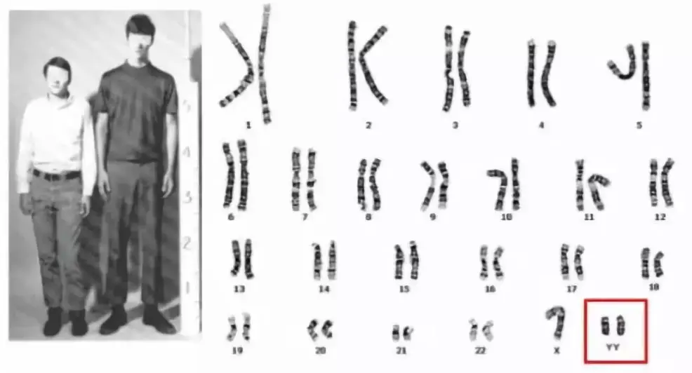 核型為(47,xyy);女性多了一條(或幾條)x染色體,則為