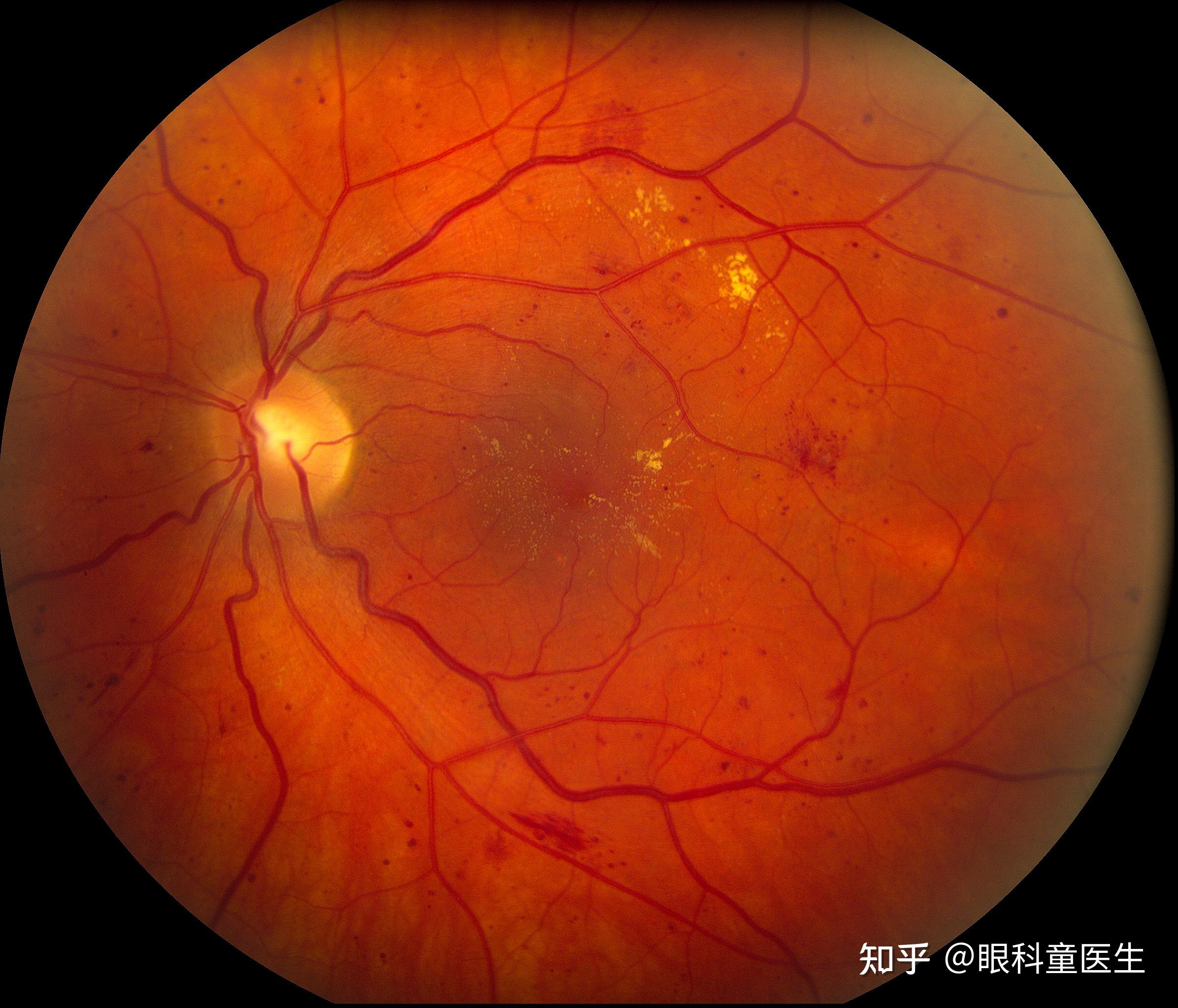 糖尿病性视网膜病变(dr)