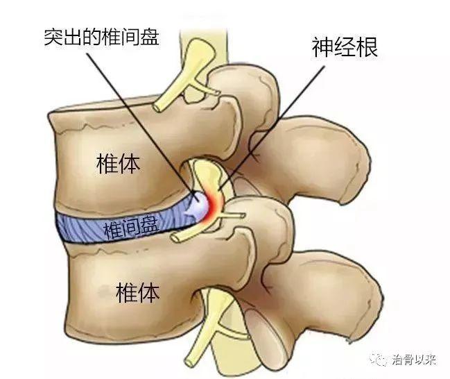 腰间盘突出该怎么办 腰间盘突出能复位吗